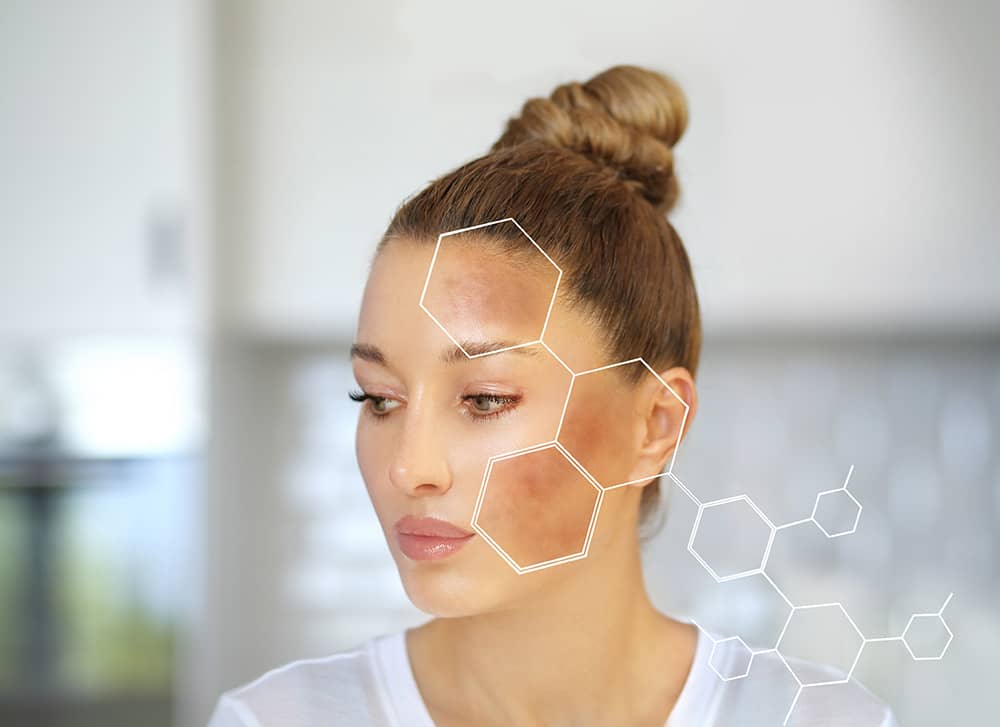 melasma-treatment-idahofalls - Ridgeline Aesthetics