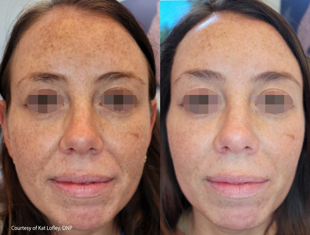 before-after-skin-tightening-1 - Ridgeline Aesthetics
