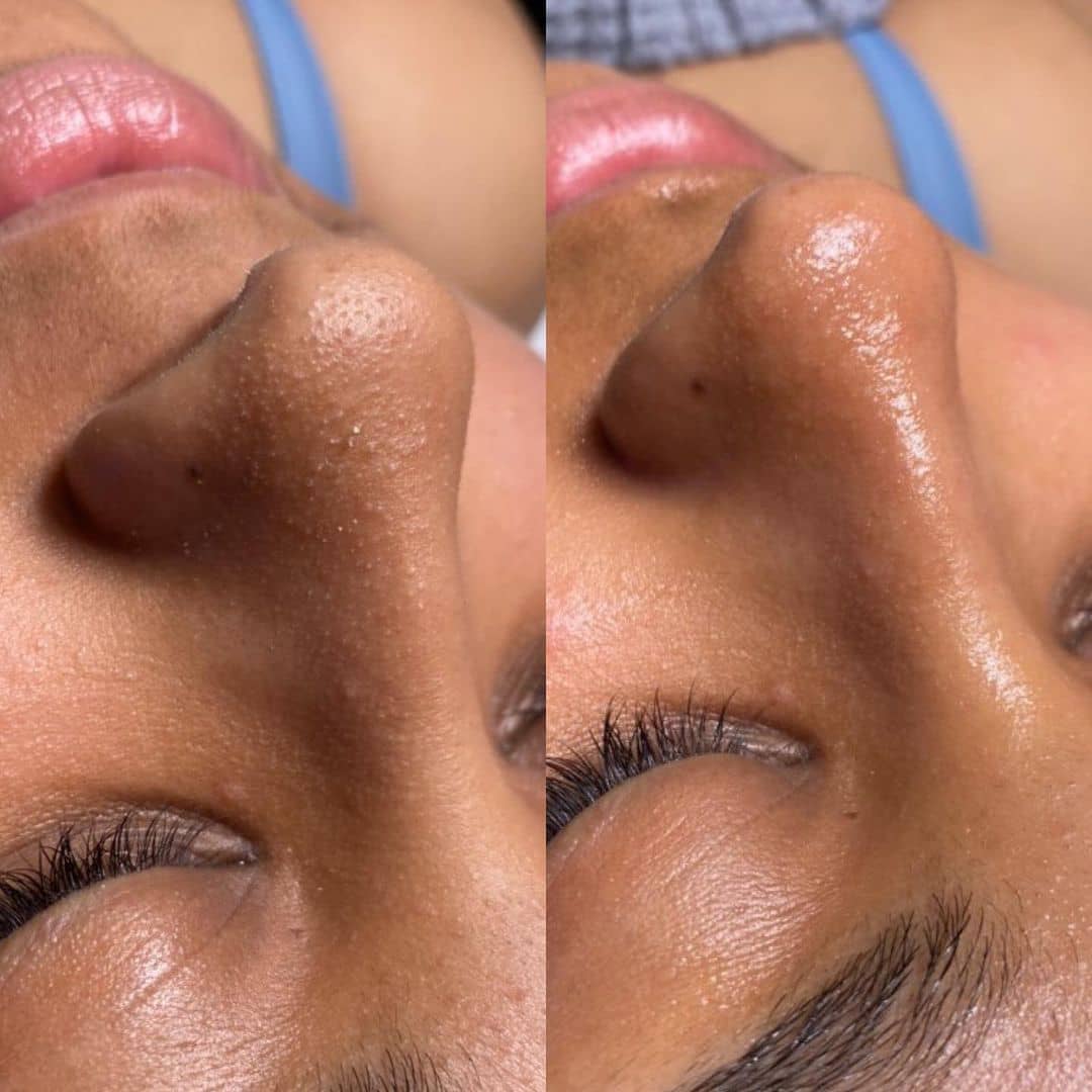 Forehead skin after laser resurfacing treatment