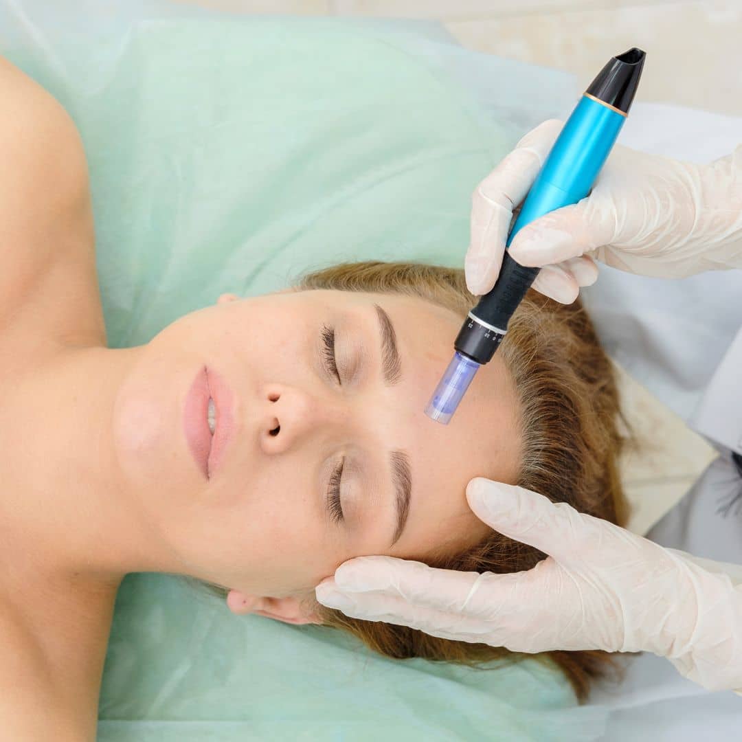 microneedling stock photo 2 - Ridgeline Aesthetics