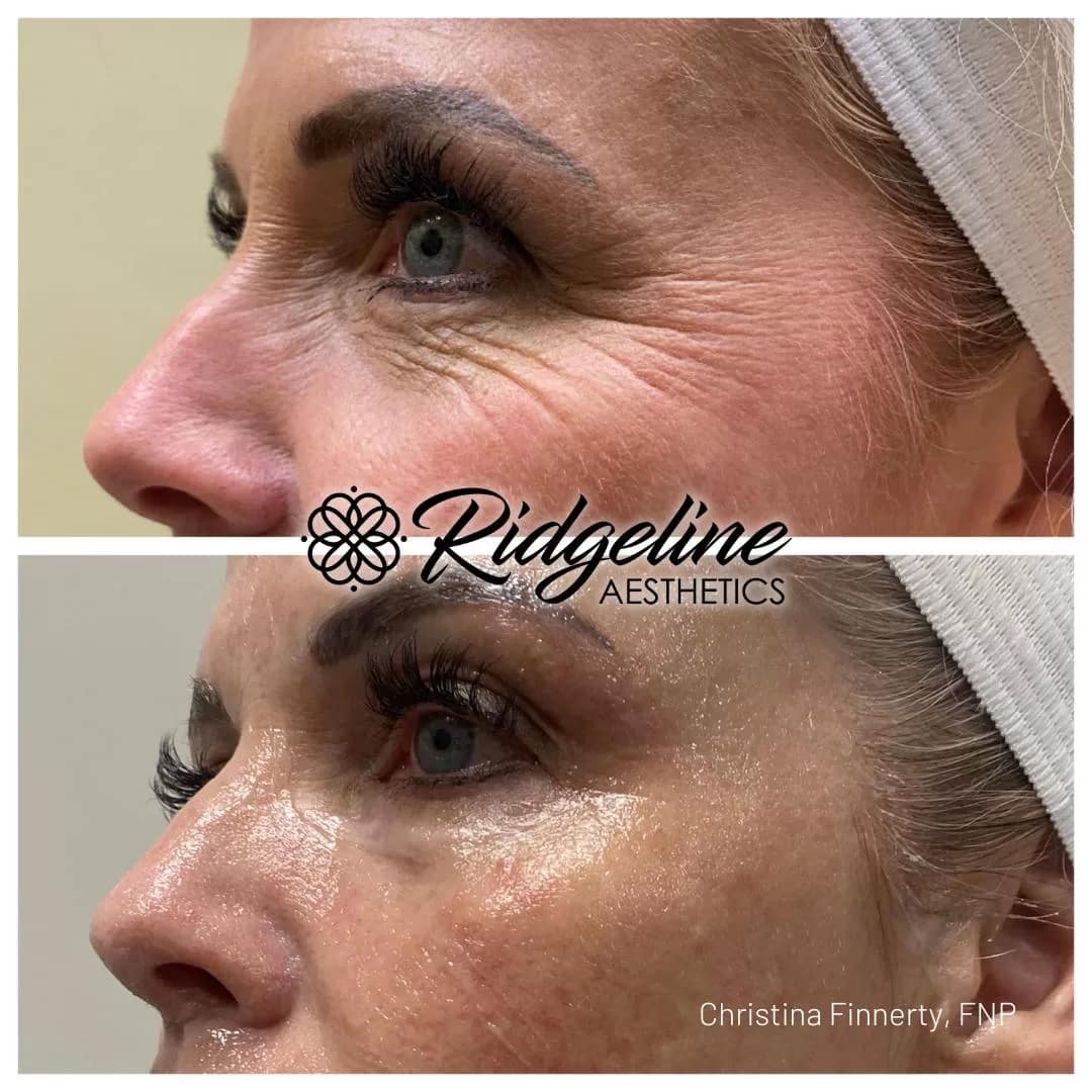 Skin-Tightening-Before-After-Opus-Ridgeline1 - Ridgeline Aesthetics