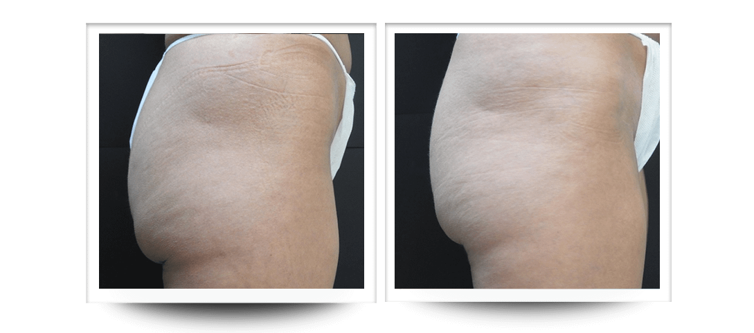 Body Sculpting | Buttocks Cellulite Results