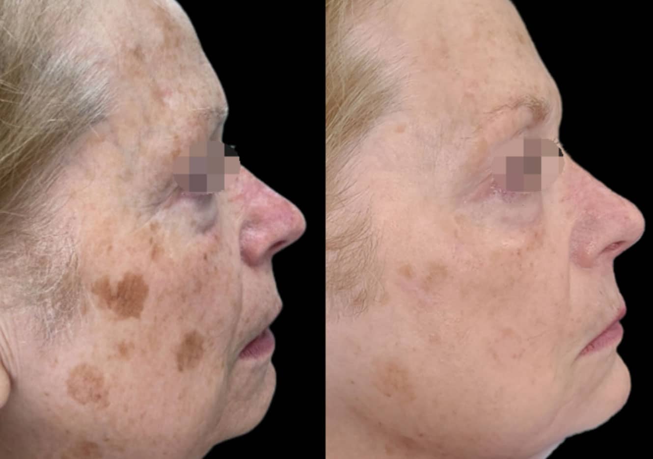 Harmony XL Pro ClearLift before and after