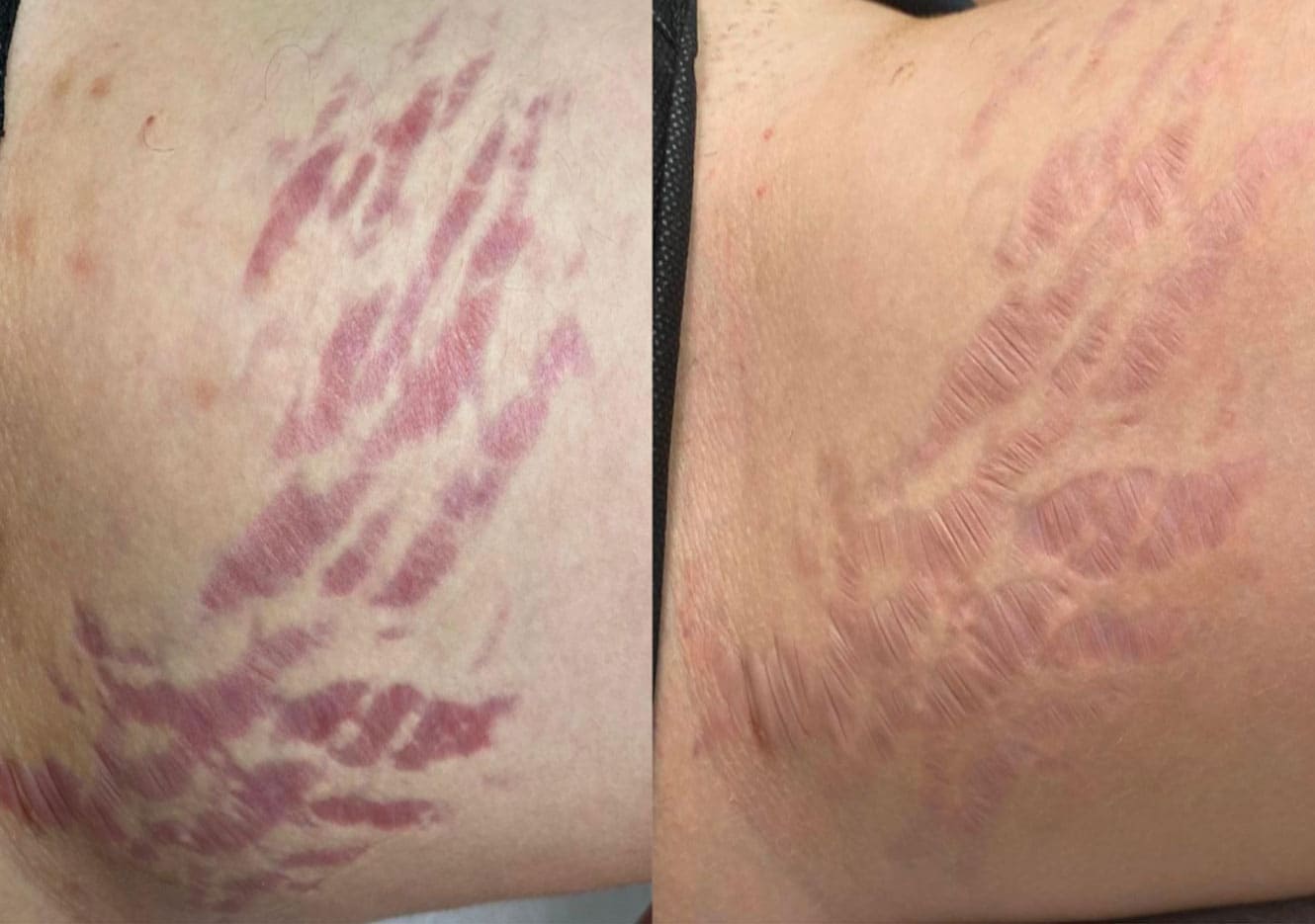 Harmony laser stretch marks before and after results