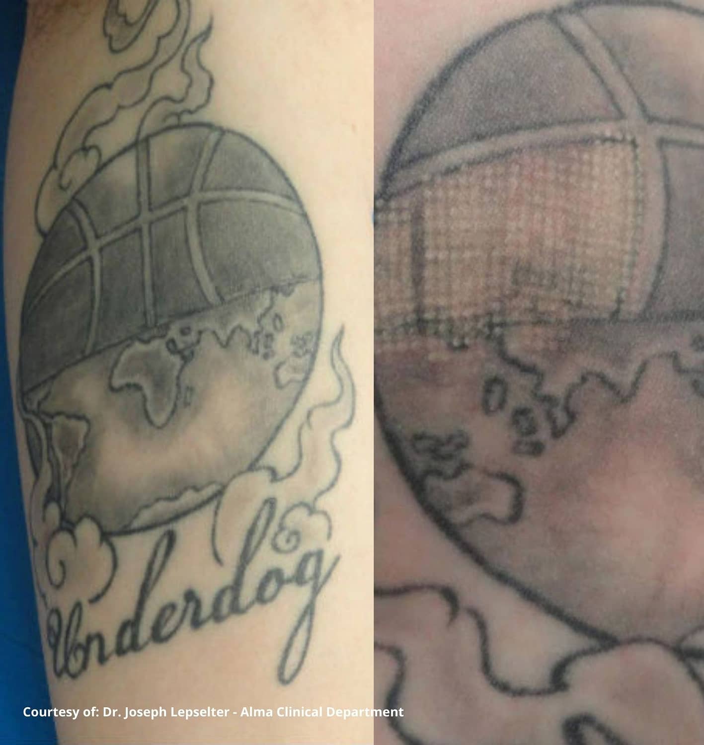 tatoo-removal-treatment-before-after - Ridgeline Aesthetics