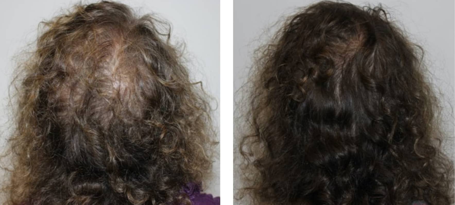 Scalp treatment to minimize thinning hair