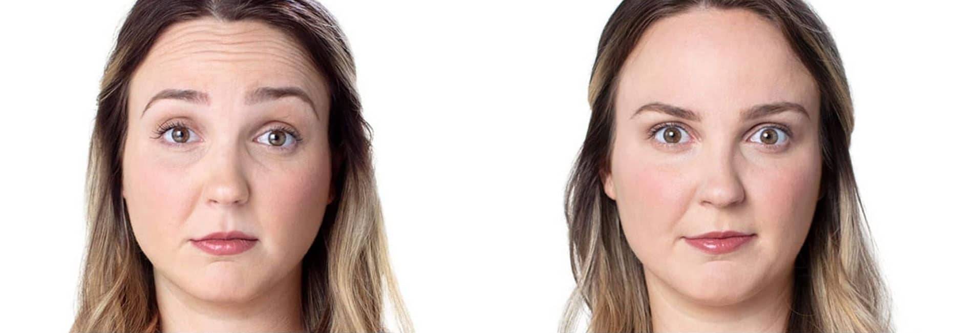 Botox before and after forehead lines