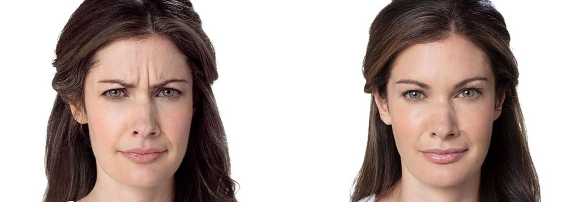 botox-results-crows-feet-and-wrinkles - Ridgeline Aesthetics Botox before and after crows feet and fine lines
