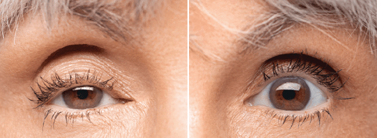 Eyelid lifting drops before and after example