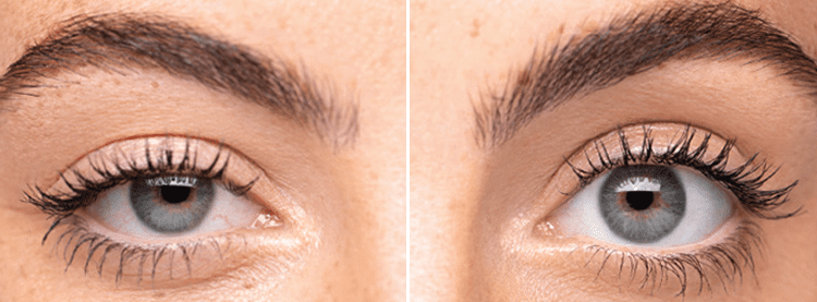 Eyelid lifting drops before and after example