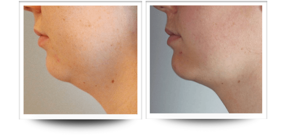 Accent Prime body sculpting neck results